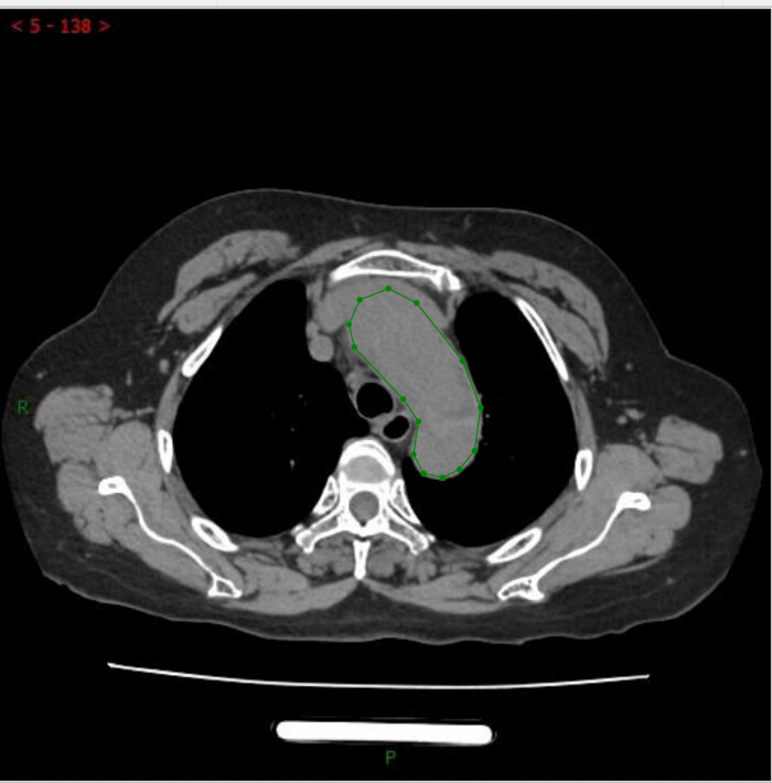 figure-protocol-1 CT scan cross-section, annotated mediastinal structure; diagnostic imaging, thoracic anatomy analysis.