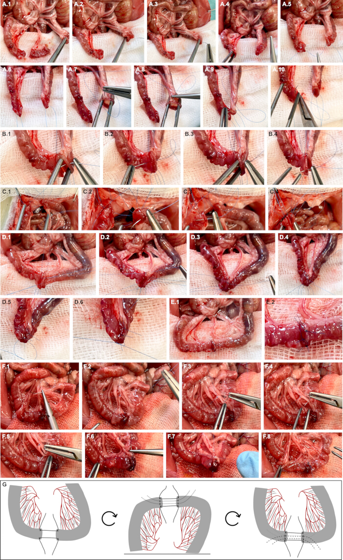 figure-protocol-4 Surgical anastomosis process; intestinal repair; step-by-step procedure; medical diagram.