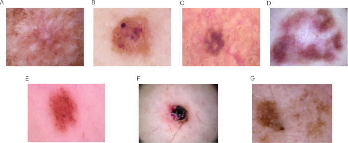 figure-protocol-2 Dermatology analysis; Skin lesion images A-G; Clinical examination; Melanoma detection study.