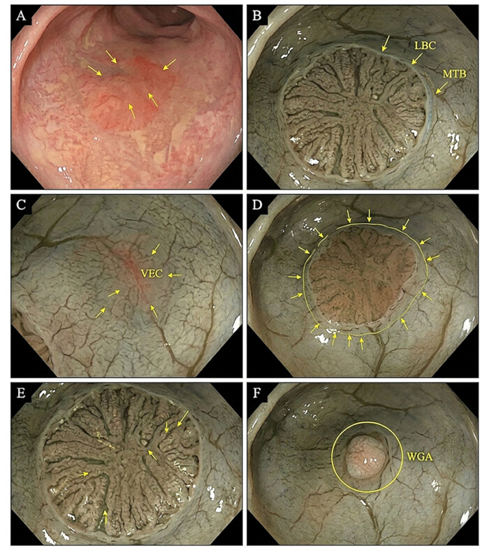 Colonoscopy images illustrating tissue identification, annotated labels, medical diagnostic process.