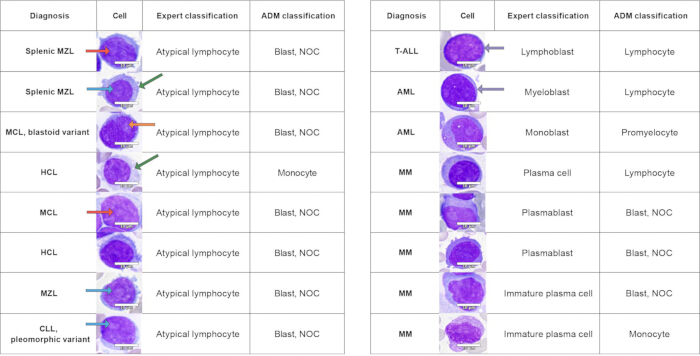 figure-results-5 Diagnostic cell classification table; lymphocyte types; blast; atypical lymphocyte; microscopy.