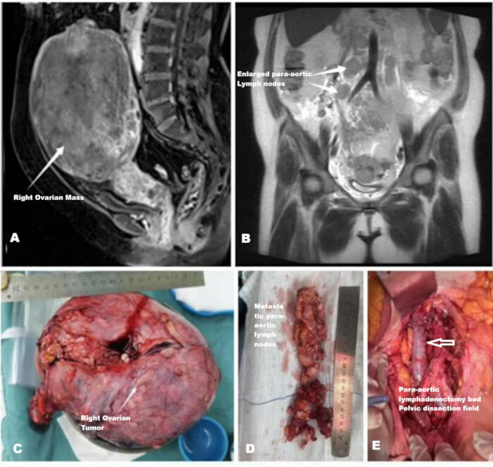 Ovarian cancer diagnosis; MRI and surgical findings, right ovarian mass and lymph node assessment.