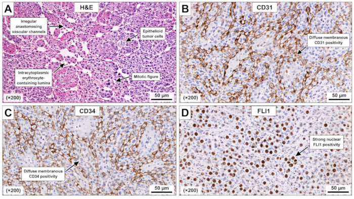 Histology and immunohistochemistry micrographs, displaying tumor cells, CD markers, and FLI1 positivity.