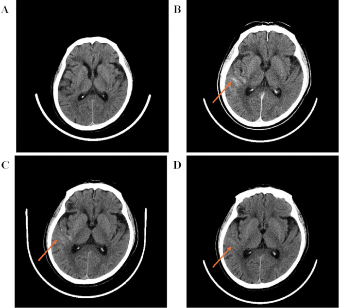 figure-results-3 CT brain scan series; arrows highlight possible lesion sites; diagnostic imaging analysis.