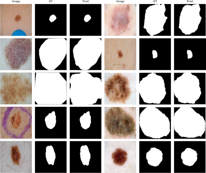 figure-results-1 Skin lesion segmentation results; image analysis; melanoma detection; diagram; dermatology research.