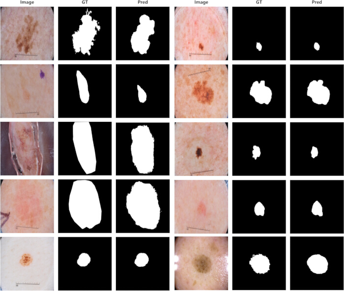 figure-results-2 Skin lesion segmentation results; dermatology image analysis, ground truth, prediction comparison.