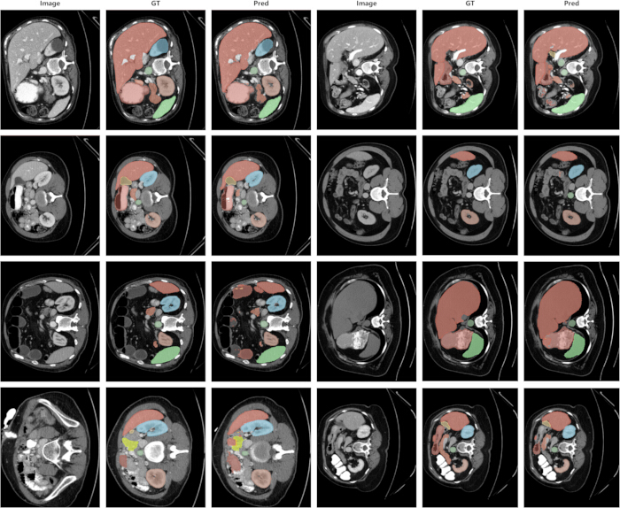 figure-results-3 CT scan segmentation comparison; original, ground truth, prediction; medical image analysis.